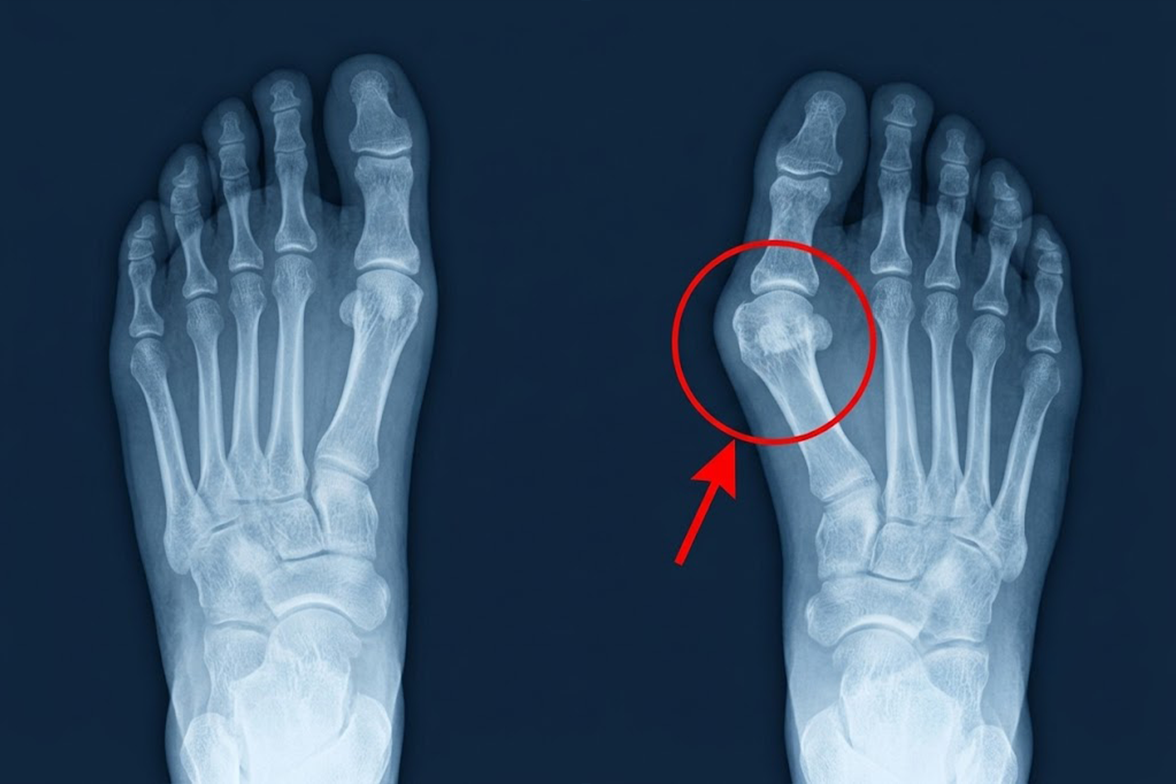 Product visual for the Evelmont Bunion Fix supplied by the advertiser.